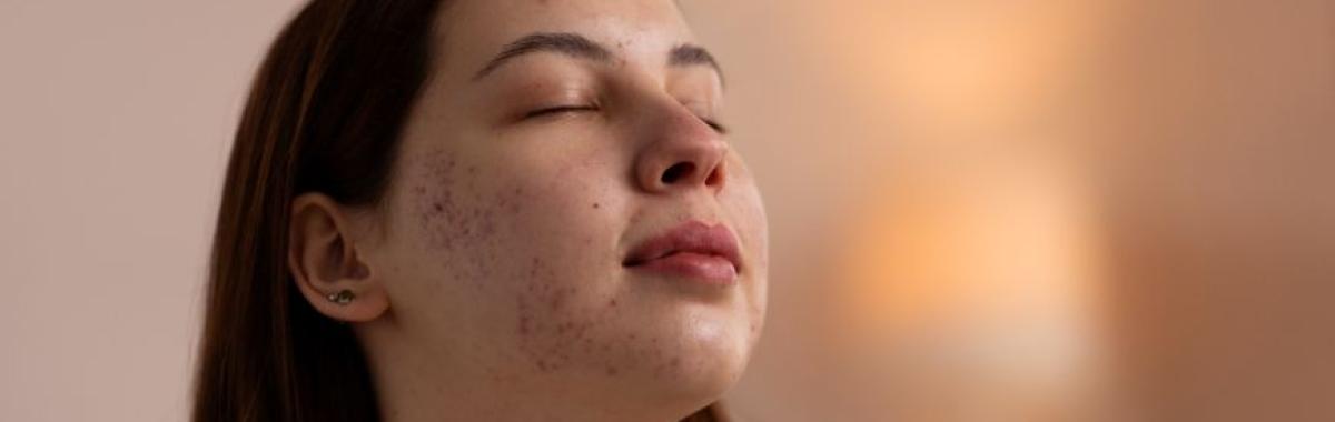 Cicatriz De Acne Ribeirão Pires