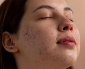 Cicatriz De Acne Ribeirão Pires