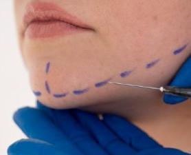 Fios De Pdo Ribeirão Pires