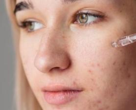 Tratamento De Cicatriz De Acne Ribeirão Pires