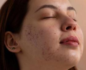 Tratamento Cicatriz De Acne Santo André