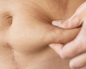 Tratamento De Flacidez Mauá