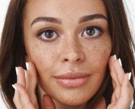 Tratamento De Melasma Mauá