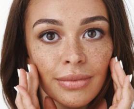 Tratamento De Melasma Ribeirão Pires