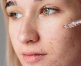 Tratamento Para Acne