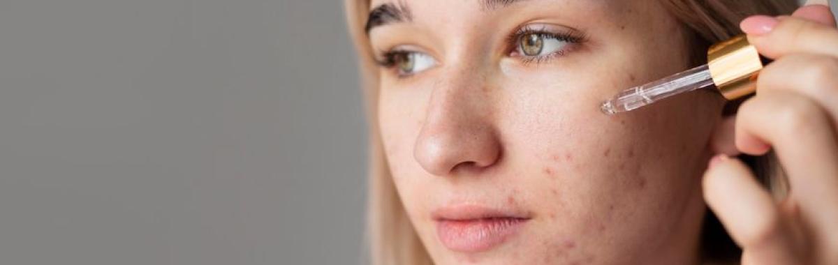 Tratamento De Cicatriz De Acne Ribeirão Pires