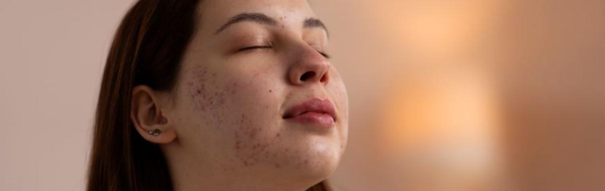 Tratamento Cicatriz De Acne Santo André