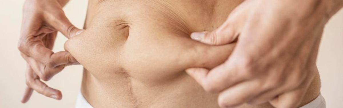 Tratamento De Flacidez Mauá