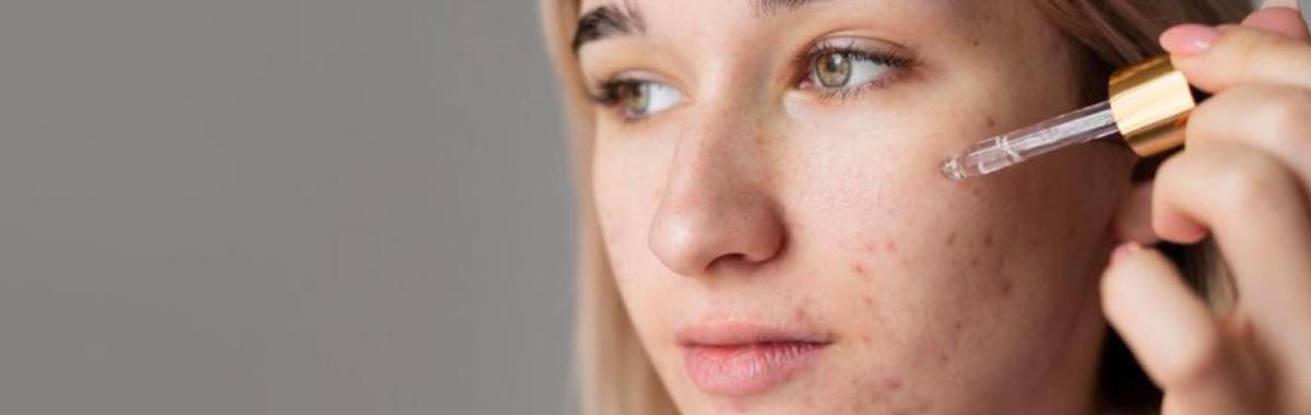 Tratamento Para Acne