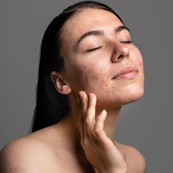 Tratamento Cicatriz Acne
